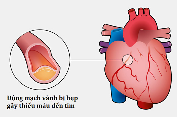 Thiếu máu cơ tim là căn bệnh phổ biến ở nước ta
